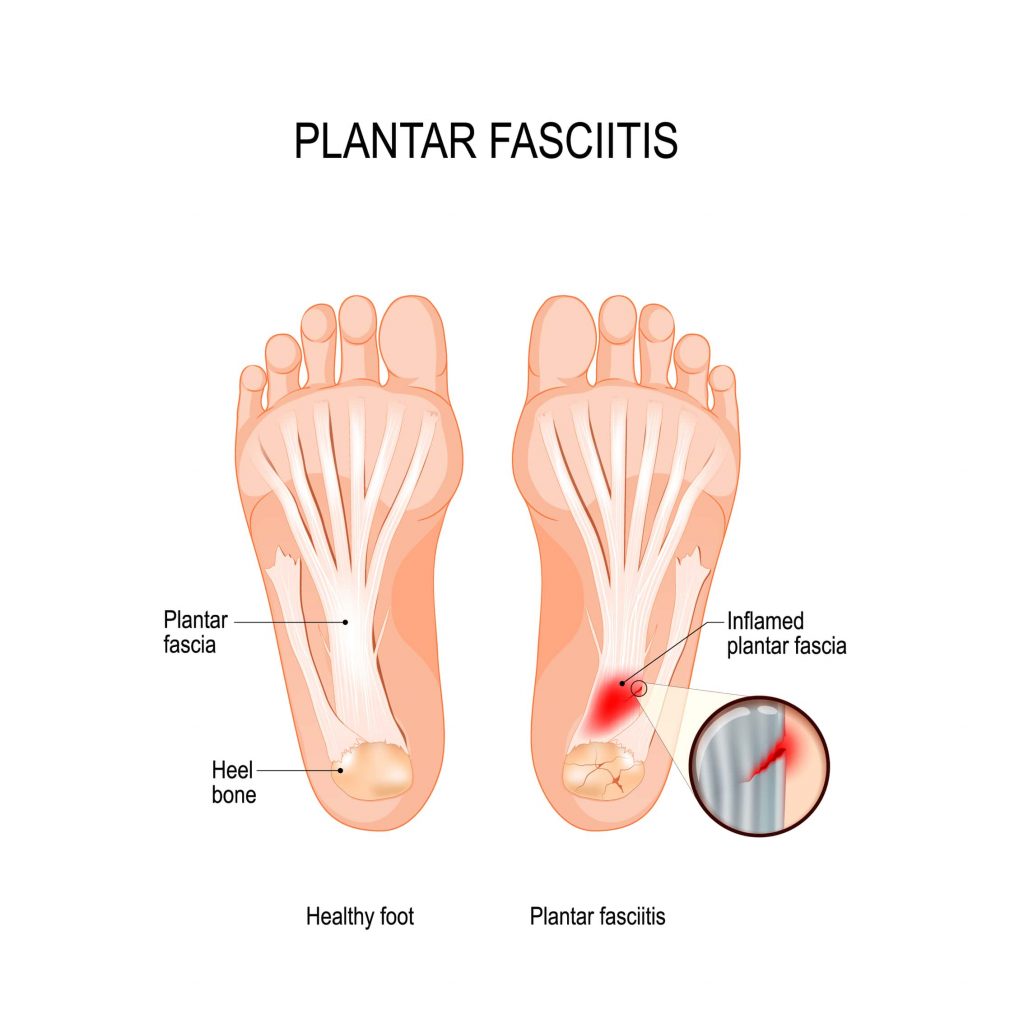 Free run for plantar fasciitis best sale