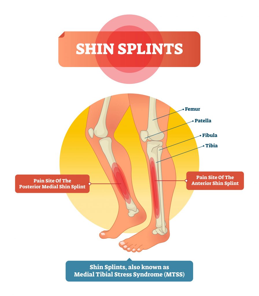 How To Tape Feet For Shin Splints Recovery